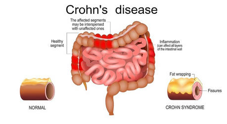 How Daily Diet Affects Crohn is Disease: The Immortal Cancer