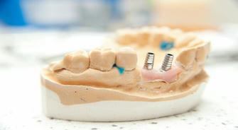 Dental Implants: Are They Safe